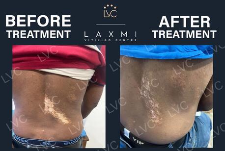 Chennai, Health, Effective Vitiligo & Leucoderma Cure | Authentic Homeopathy In Madurai