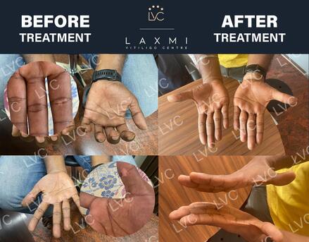 Chennai, Health, Effective Vitiligo & Leucoderma Cure | Authentic Homeopathy In Madurai