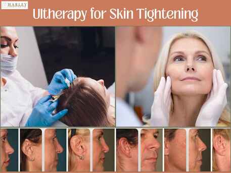 New York, Health, Non-Surgical Skin Tightening With Ultherapy In Atlanta