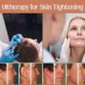 Non-Surgical Skin Tightening With Ultherapy In Atlanta