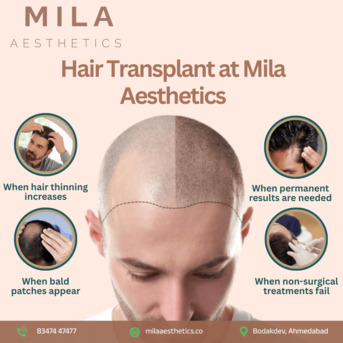 Ahmedabad, Health, Best Hair Transplant In Ahmedabad With Mila Aesthetics