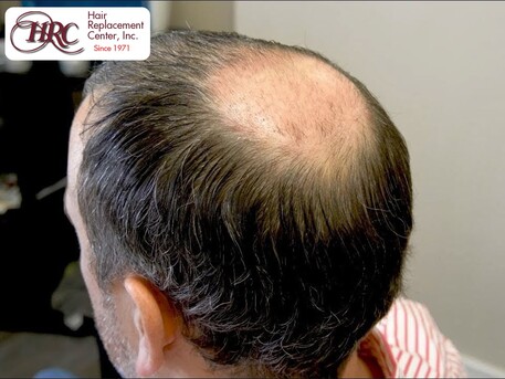 Los Angeles, Business, Mens Toupee In Los Angeles, CA