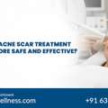Best Acne Scar Treatment Near Me In Bangalore