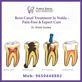 Noida, Dental, Root Canal Treatment In Noida