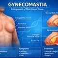 Gynecomastia Surgery In Pune | Male Breast Reduction