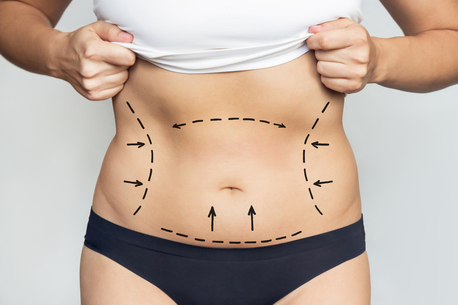 New Delhi, Health, Best Tummy Tuck Treatment In Delhi By Resplendent Cosmetics
