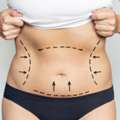 Best Tummy Tuck Treatment In Delhi By Resplendent Cosmetics
