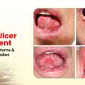 Effective Mouth Ulcer Treatment For Long-Lasting Relief