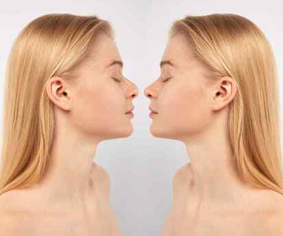 Cape Town, Health, Nose Surgery In Cape Town &ndash; Expert Rhinoplasty For Natural, Confident Results