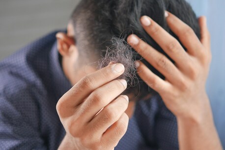 Ahmedabad, Health, Best Doctors For Hair Loss Treatment In Ahmedabad