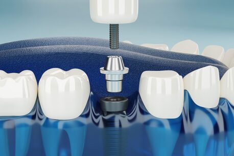 Washington DC, Dental, Dentures Implants Recovery: What To Expect After Implant Replacement ?