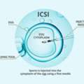 ICSI Treatment In Delhi - Dr Rhythm Gupta
