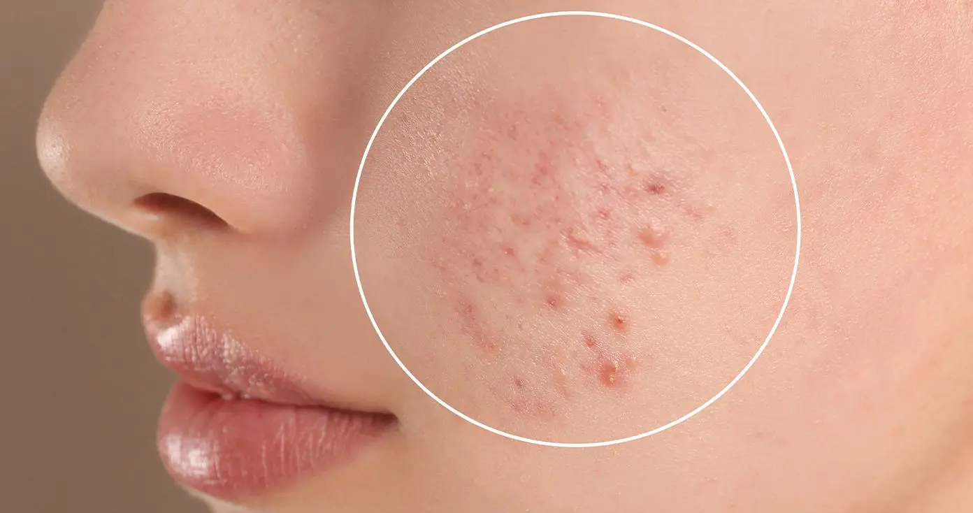 New York, Health, Invisible Patch For Covering Active Pimples