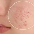 Invisible Patch For Covering Active Pimples