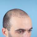 No.1 Hair Transplant Clinic In Thane At DNA Royal: Understanding Advanced Hair Restoration