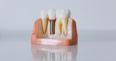 Sydney, Health, Dental Implants Port Macquarie &ndash; Restore Your Smile Today