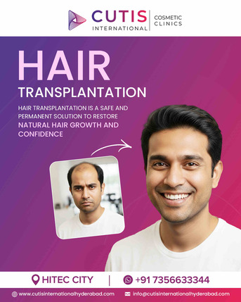 Hyderabad, Health, No.1 Hair Transplant Clinic In Hyderabad For Men & Women