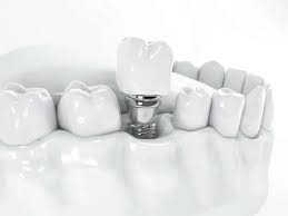 Singapore, Dental, How To Choose The Right Fixed Retainer For Your Needs