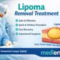 Lipoma Treatment In Delhi: Causes, Symptoms & Removal Options