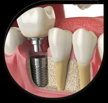 Singapore, Dental, Surgery For Dental Implants