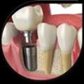Surgery For Dental Implants