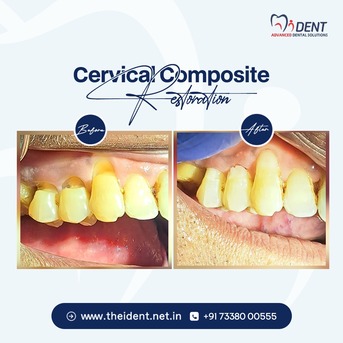 Bangalore, Dental, Expert Root Canal Specialist In Kadugodi  Gentle Care, Fast Recovery