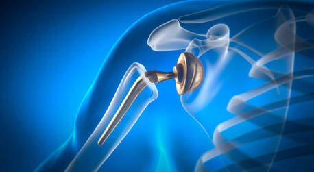 New York, Health, Dr. Michael J. Bercik Jr., MD Ranks In Top 1% Nationally For Shoulder Replacement Surgerie