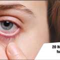 20 Home Remedies For Itchy Eyes Or Dry Eyes