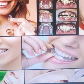 Pune, Dental, Dr Mathesul Invisalign Orthodontist Braces & Dental Implant    Clinic