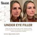 Professional Under Eye Filler In Newport Beach