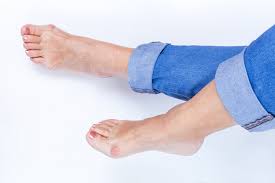 Singapore, Health, Preparing For Keyhole Bunion Surgery What To Know