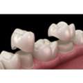 Dental Crowns In Rockland County, NY