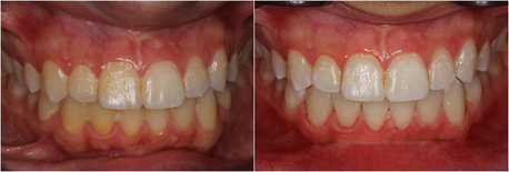 New York, Dental, Teeth Whitening Columbus Ohio At Dublin Metro Dental