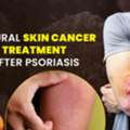 Natural Skin Cancer Treatment After Psoriasis &ndash; Insights By Acharya Manish Ji