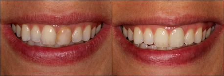 New York, Dental, Natural-Looking Porcelain Crowns At Dublin Metro Dental
