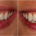 Natural-Looking Porcelain Crowns At Dublin Metro Dental