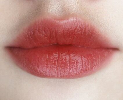 Toronto, Health, Lip Injections Toronto For Natural And Beautiful Results