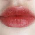 Lip Injections Toronto For Natural And Beautiful Results