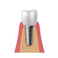 Kolkata, Dental, Dental Implant Surgery &ndash; A Permanent And Reliable Solution For Missing Teeth