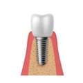 Dental Implant Surgery &ndash; A Permanent And Reliable Solution For Missing Teeth
