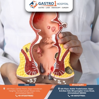 Ahmedabad, Health, Best Piles Treatment In Ahmedabad With Latest Laser Technology