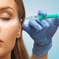 Are You Looking Microneedling Treatment In London?