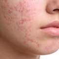 Acne Products In Thane At DNA Royal | Clear Skin Solutions For All Ages