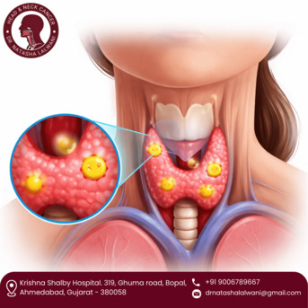 Ahmedabad, Health, Get Expert Parathyroid Tumor Treatment In Ahmedabad - Dr. Natasha Lalwani