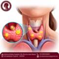 Get Expert Parathyroid Tumor Treatment In Ahmedabad - Dr. Natasha Lalwani