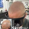 Best Scalp Micropigmentation London