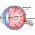 Advanced Glaucoma Treatment In Dubai For Clear Vision