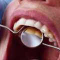 Who Should Consider Teeth Scaling And Polishing?