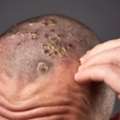 Scalp Psoriasis: Symptoms, Causes & Treatment | Best Psoriasis Treatment In India