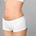 What Is The Best Age For Liposuction Surgery?